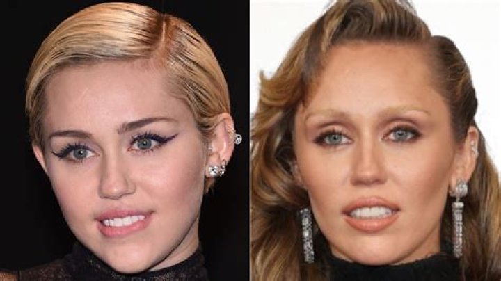 Miley Cyrus' Buccal Fat Removal Journey