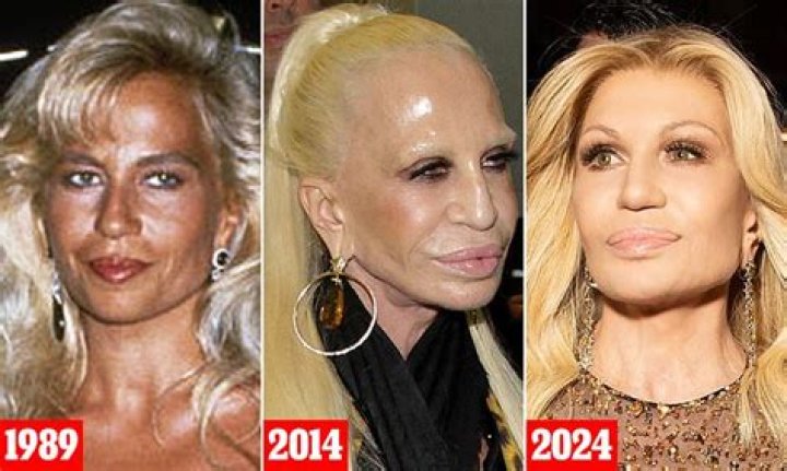 Unveiling The Transformation: Versace's Plastic Surgery Journey